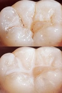 composite dental filling