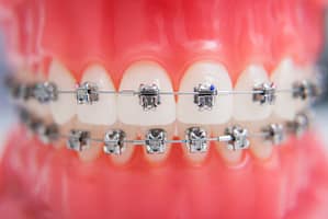 self ligating braces