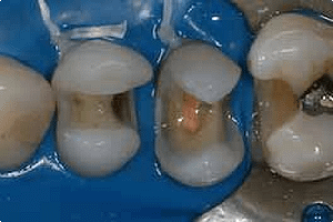 Initial aspect of the tooth after rubber dam placement and removal of the temporary