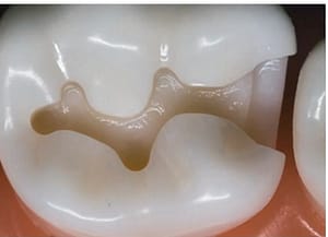 preserving cuspal strength