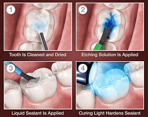 pit fissure procedure