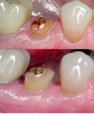 Can a Damaged Tooth Be Restored,Can a severely damaged tooth restorable,Dental Post,Crown Lengthening
