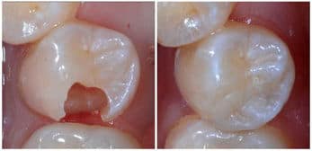 composite dental filling
