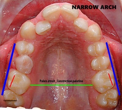 narrow upper jaw