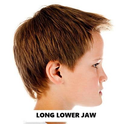 jaw discrepancy in kids  protruded lower