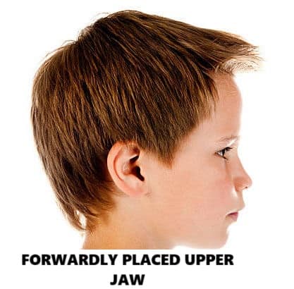 jaw discrepancy in kids protruded upper