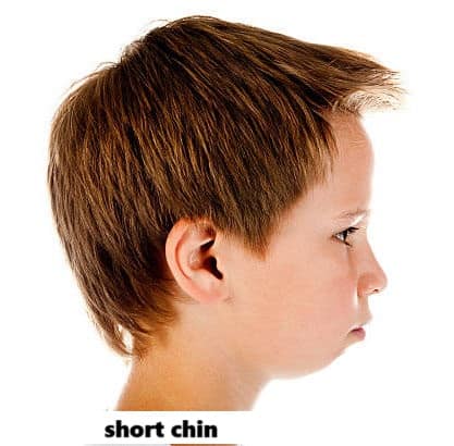 jaw discrepancy in kids  retruded lower