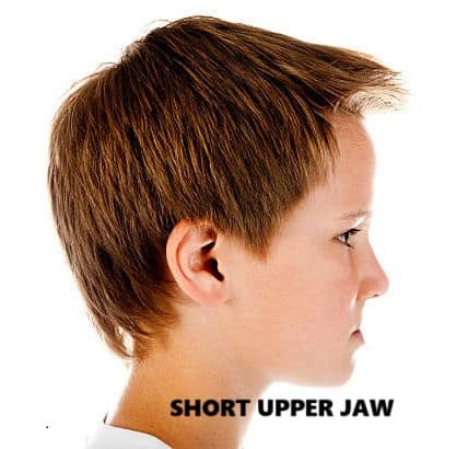 jaw discrepancy in kids  retruded upper