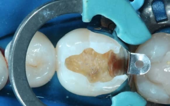 dental filling in nagercoil- siya,glass ionomer cement,composite filling,restoration in siya,dental filling in siya