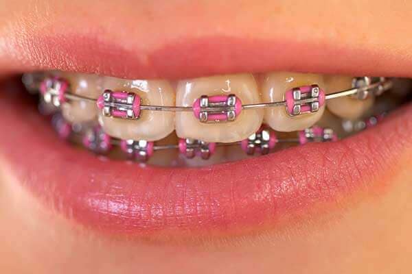 fixed braces