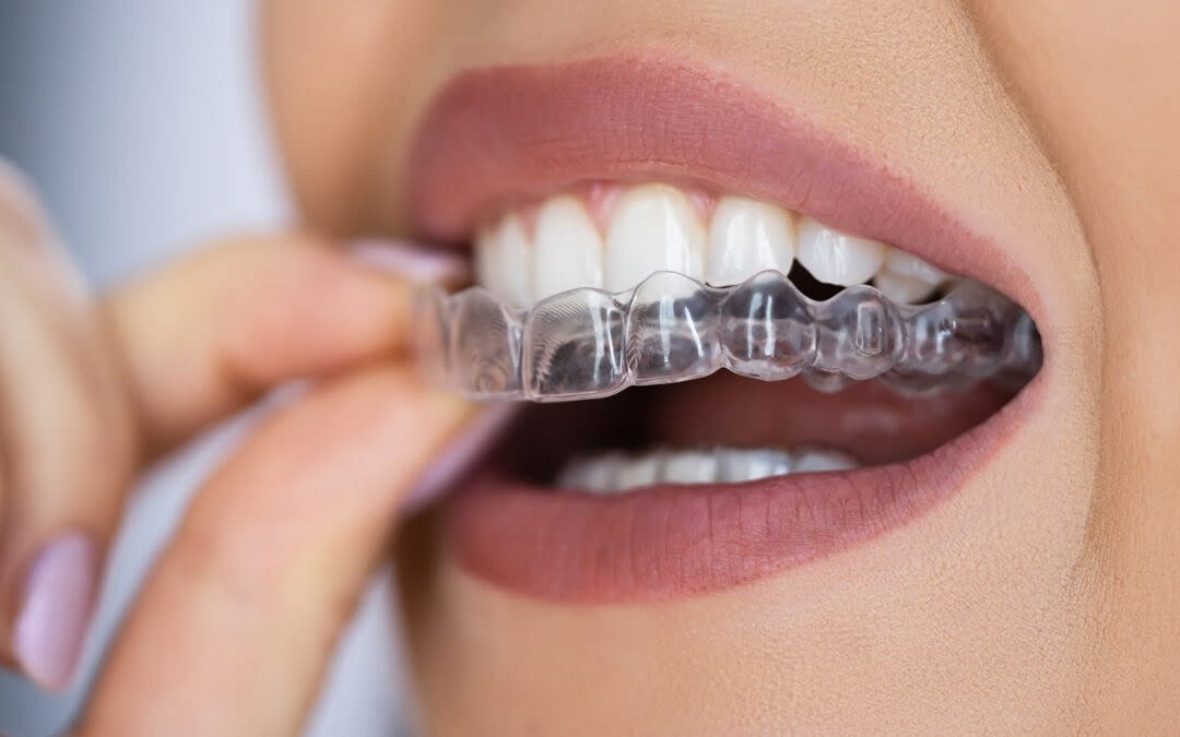 Illustrative close-up of a clear removable dental aligner